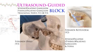 UltrasoundGuided Sphenopalatine Pterygopalatine Trigeminal Nerve Gasserian Ganglion Blocks [upl. by Camala]