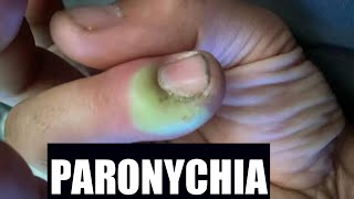 Paronychia  Katuruturu  home remedy and treatment [upl. by Becht]