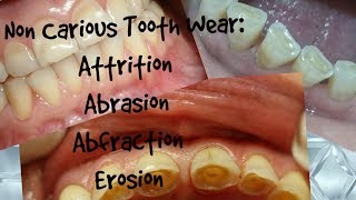 Non Carious Tooth WearAttrition Abrasion Abfraction ErosionClinical Appearance Diagnosis [upl. by Solomon761]