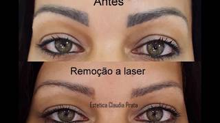 remoção a laser despigmentação de sobrancelha [upl. by Aynnek]