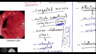 Phase 3 STELARA Study for Treatment to Ulcerative Colitis UC [upl. by Doomham]