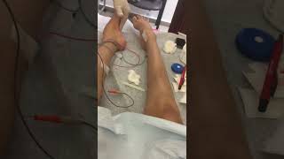 Parte de electromiografia con conducción MID [upl. by Brittnee]