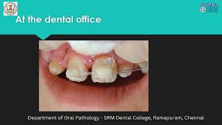 Management of Avulsed Tooth  Dr Priyadharsini N  Department of Oral Pathology [upl. by Airdnassac]