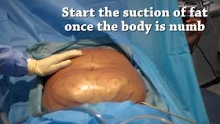 How is liposuction performed  Centre for Surgery [upl. by Gee]