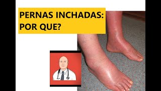 As 9 causas principais de pernas inchadas com sinais de alerta para ver o médico [upl. by Wye]