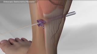 Endoscopic Gastrocnemius Recession [upl. by Lamp]