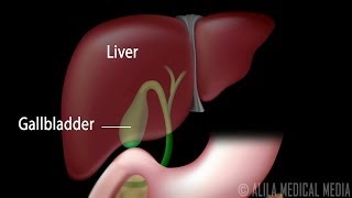 Gallstones and Surgical Removal of Gallbladder Cholecystectomy Animation [upl. by Hannus753]