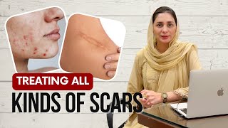 Say Goodbye to Scars Best Treatment Options Explained [upl. by Chaille]