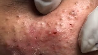 How to remove blackheads and whiteheads at homeHow to remove acne30 [upl. by Benis]