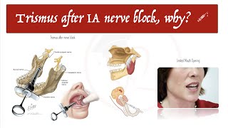 Trismus after Inferior Alveolar Nerve Block 💉 Why 🧐  Part 1 [upl. by Atirahc]