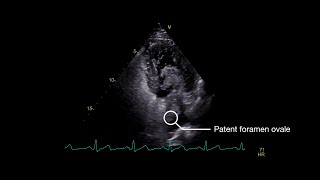 Stroke From Paradoxical Embolism Through a Patent Foramen Ovale [upl. by Eninaej]