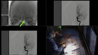 Expanding the indications for endovascular thrombectomy in ischemic stroke [upl. by Balfour784]