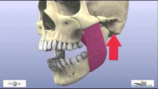 fracture of the mandibular condyle part 2 [upl. by Ilojna]