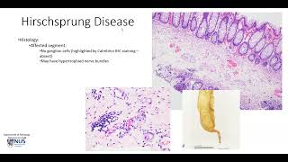 Colon Hirschsprung disease [upl. by Malcolm]