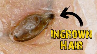 Ingrown Hair Removal x Satisfying Blackheads [upl. by Ashleigh]