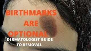 How to remove birthmarks [upl. by Hgielac]