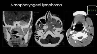 Radiology  Suprahyoid neck  Parapharyngeal spaces [upl. by Ver]