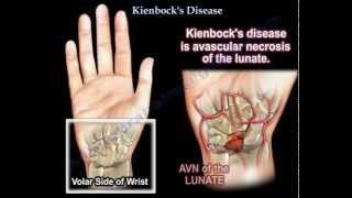 Kienbocks Disease  Everything You Need To Know  Dr Nabil Ebraheim [upl. by Neeoma]