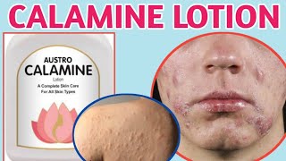 Calamine lotion  calamine lotion uses  calamine lotion uses in hindi [upl. by Yahsan302]