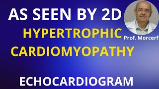 Full Insight into 2D Echo Aspect of Hypertrophic Cardiomyopathy [upl. by Brok]