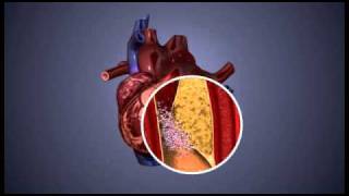 Atherosclerosis  3D Animation  ABP © [upl. by Lumbye]