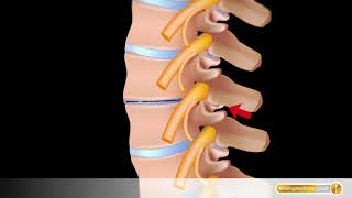 Spondylose der Wirbelsäule mit Schäden an Facettengelenken und Bandscheiben [upl. by Sualkin]