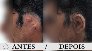 Prótese de Silicone Orelha Microtia [upl. by Lonergan718]