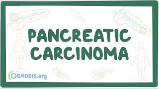 7 Signs and Symptoms of Pancreatic Cancer [upl. by Medovich]