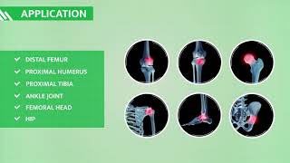 ORTHOPLASTY™  BPB MEDICA™  Subchondral Bone Marrow Lesions BMLs treatment kit [upl. by Enorel]