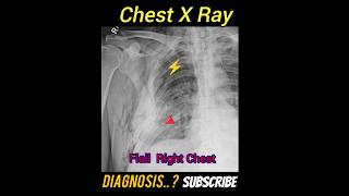 Flail chest  Diagnosis  CXR PA Practical case  Radiology [upl. by Bore812]