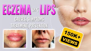 Eczema on lips causes symptoms treatment remedies prevention  Lip dermatitis Lip Cheilitis [upl. by Otanutrof416]