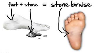 Stone Bruise Foot Pain HOME Treatment [upl. by Shelden]