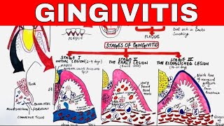 Gingivitis  Stages of Gingival Inflammation [upl. by Gerrard]