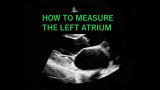 ECHOCARDIOGRAM How to measure the Left Atrium Diameter [upl. by Akitan262]