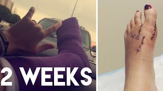 2 weeks after bunion surgery Recovery video [upl. by Alard]