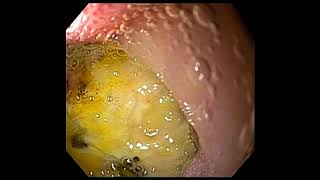 Duodenal ulcer [upl. by Esinereb33]