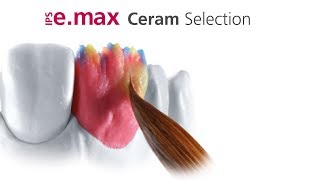 IPS emax Ceram Selection [upl. by Ola163]