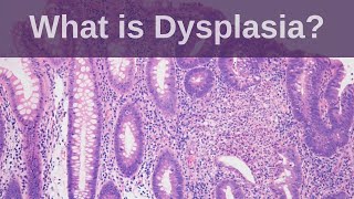 What is Dysplasia  Pathology mini tutorial [upl. by Claiborne]