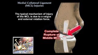 Medial Collateral Ligament Injuries  Everything You Need To Know  Dr Nabil Ebraheim [upl. by Fabio176]