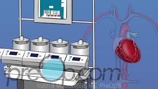 Coronary Artery Bypass Graft CABG Surgery  PreOp® Patient Education [upl. by Yenoh]