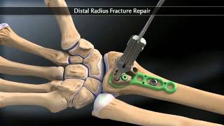 Arthrex Distal Radius Fracture Fixation [upl. by Winton]