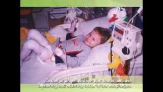 Epidermolysis Bullosa EB Awareness video extended [upl. by Acirret]