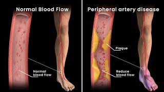 Peripheral Artery Disease Angioplasty [upl. by Akinej]