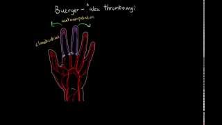 Buerger Disease [upl. by Noremac587]