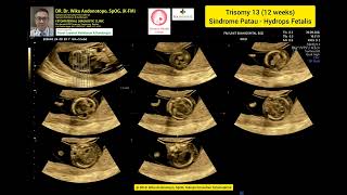 Sindroma Patau Trisomi 13 12 Weeks [upl. by Rekoob617]