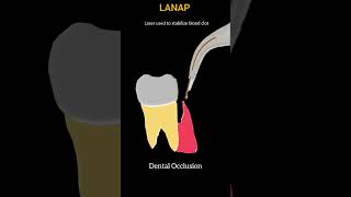 LANAP  Laser Assisted New Attachment Procedure Steps shorts dentist periodontology short [upl. by Benedetta379]