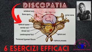 DISCOPATIA LOMBARE L4L5L5S1  6 ESERCIZI EFFICACI [upl. by Adnawad]