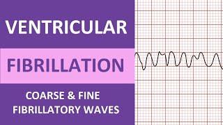 Ventricular Fibrillation VFib ECG Interpretation Nursing Heart Rhythms NCLEX ACLS [upl. by Ezmeralda283]