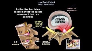 Low Back Pain amp Disc Herniation  Everything You Need To Know  Dr Nabil Ebraheim [upl. by Oiled327]