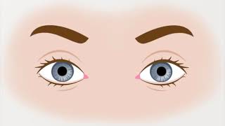 Animation of Right Upbeating Torsional Nystagmus seen in BPPV [upl. by Yriek]